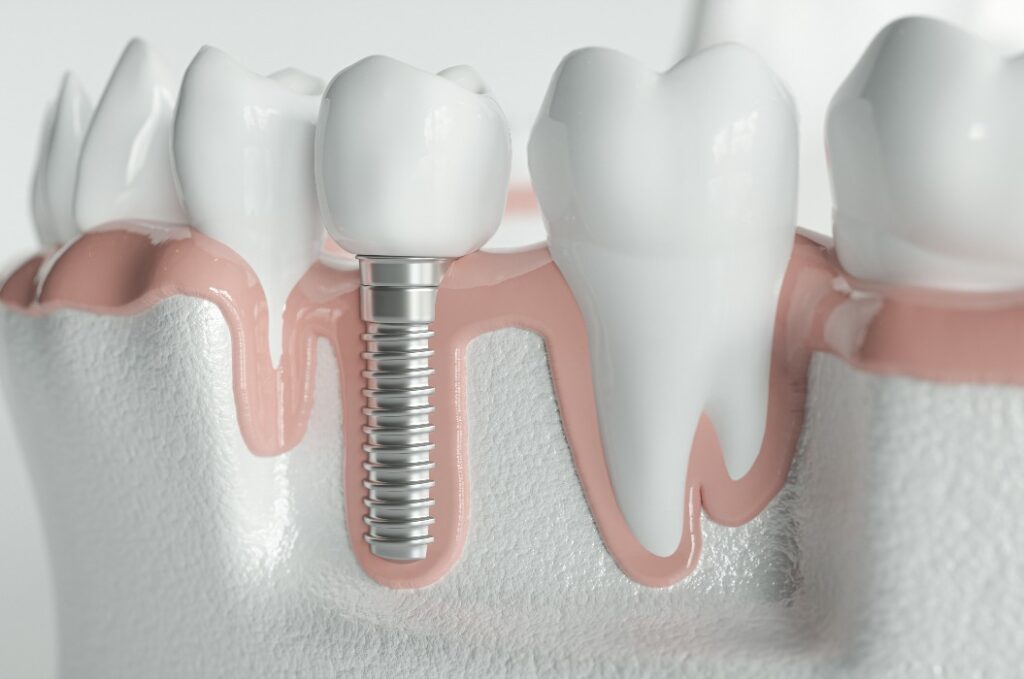 Gesunde Zähne und ein Implantat - 3D-Darstellung
